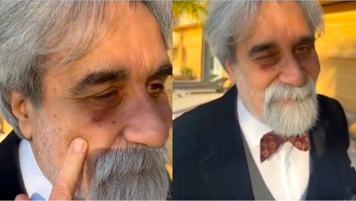 Beppe Vessicchio occhio nero 