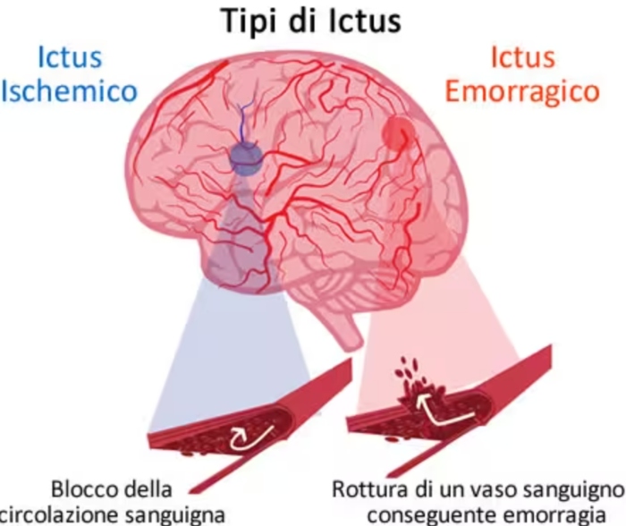 ictus infarto