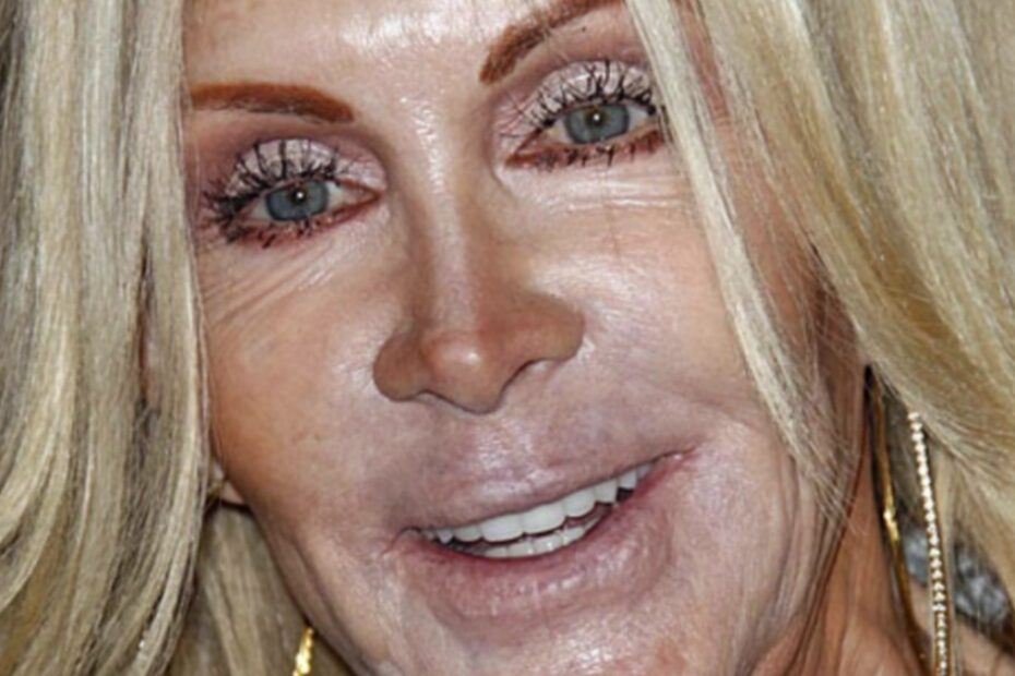 L'attrice Joan Van Ark stravolta dalla chirurgia estetica