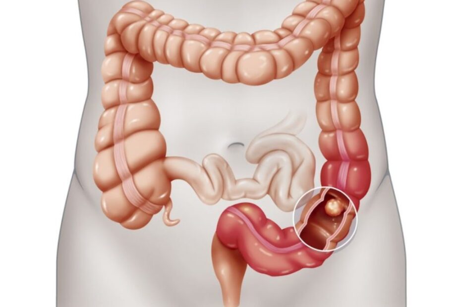 tumore al colon