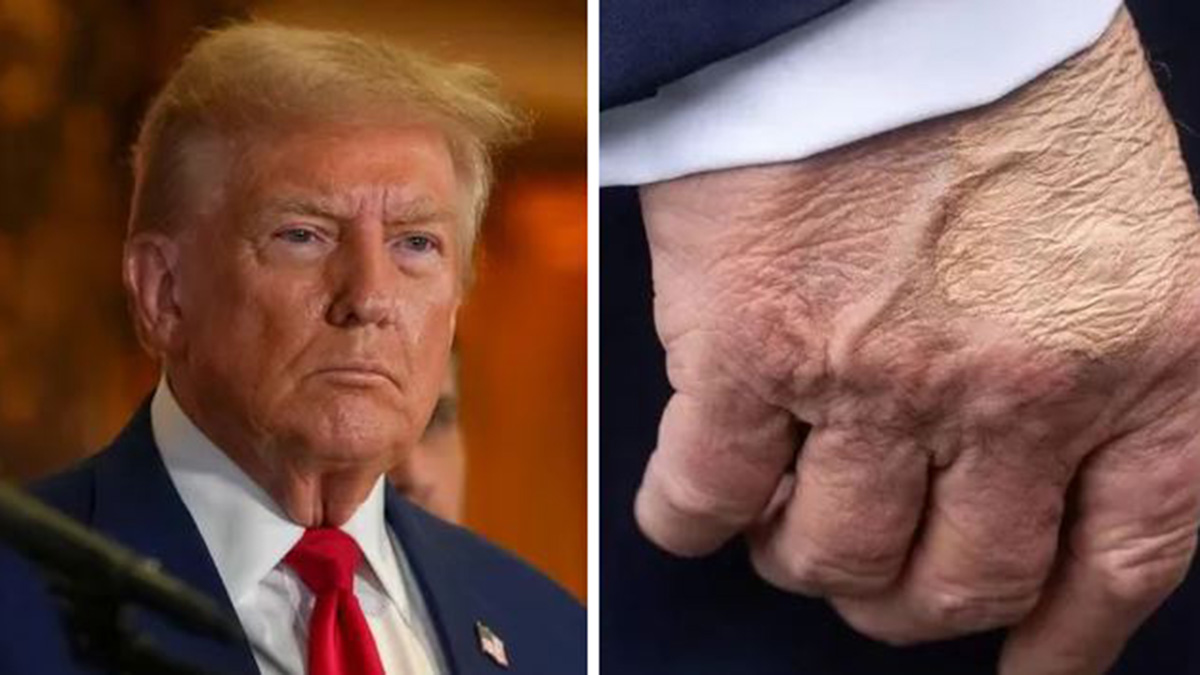 Donald Trump, preoccupano le sue condizioni: di cosa soffre il presidente Usa Donald Trump, preoccupano le sue condizioni: di cosa soffre il presidente Usa