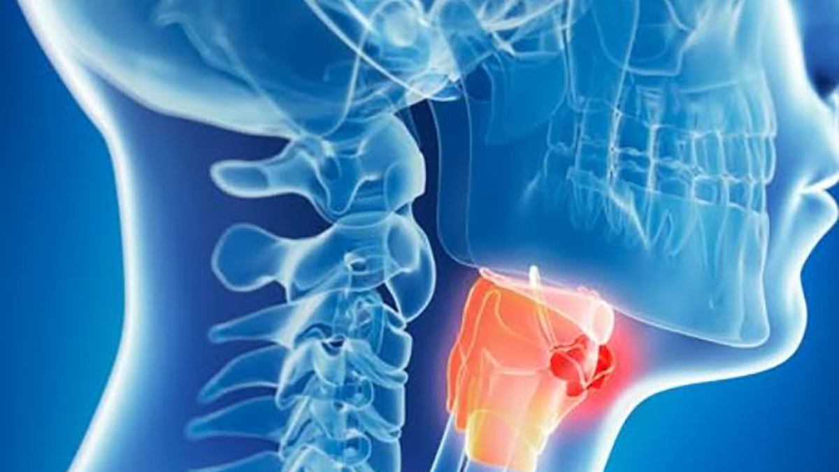 Tumori testa collo, la regola per riconoscerli: ecco i segnali da non sottovalutare Tumori testa collo, la regola per riconoscerli: ecco i segnali da non sottovalutare