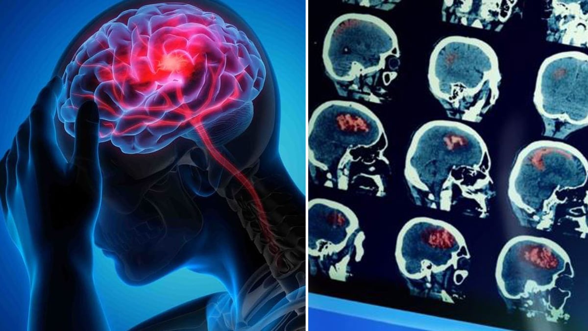 ictus quali sono i primi sintomi i campanelli d8217allarme da non sottovalutare da Tvzap.it ictus quali sono i primi sintomi i campanelli d8217allarme da non sottovalutare