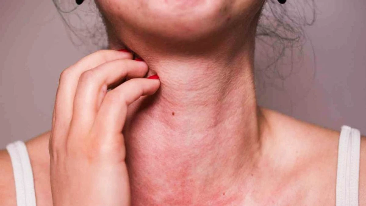 Un barbecue in famiglia: il contesto dell'insorgenza dell'allergia alfa-gal