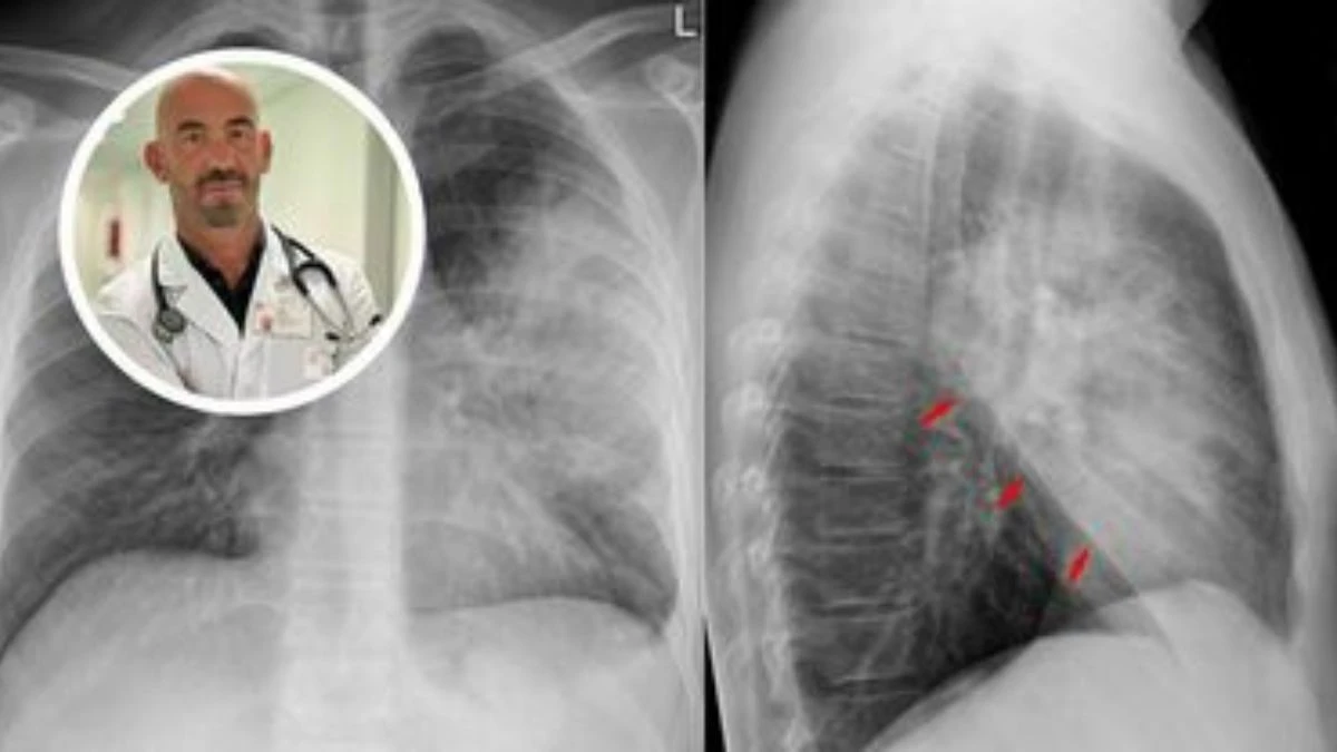 Radiografia toracica raffigurante polmonite