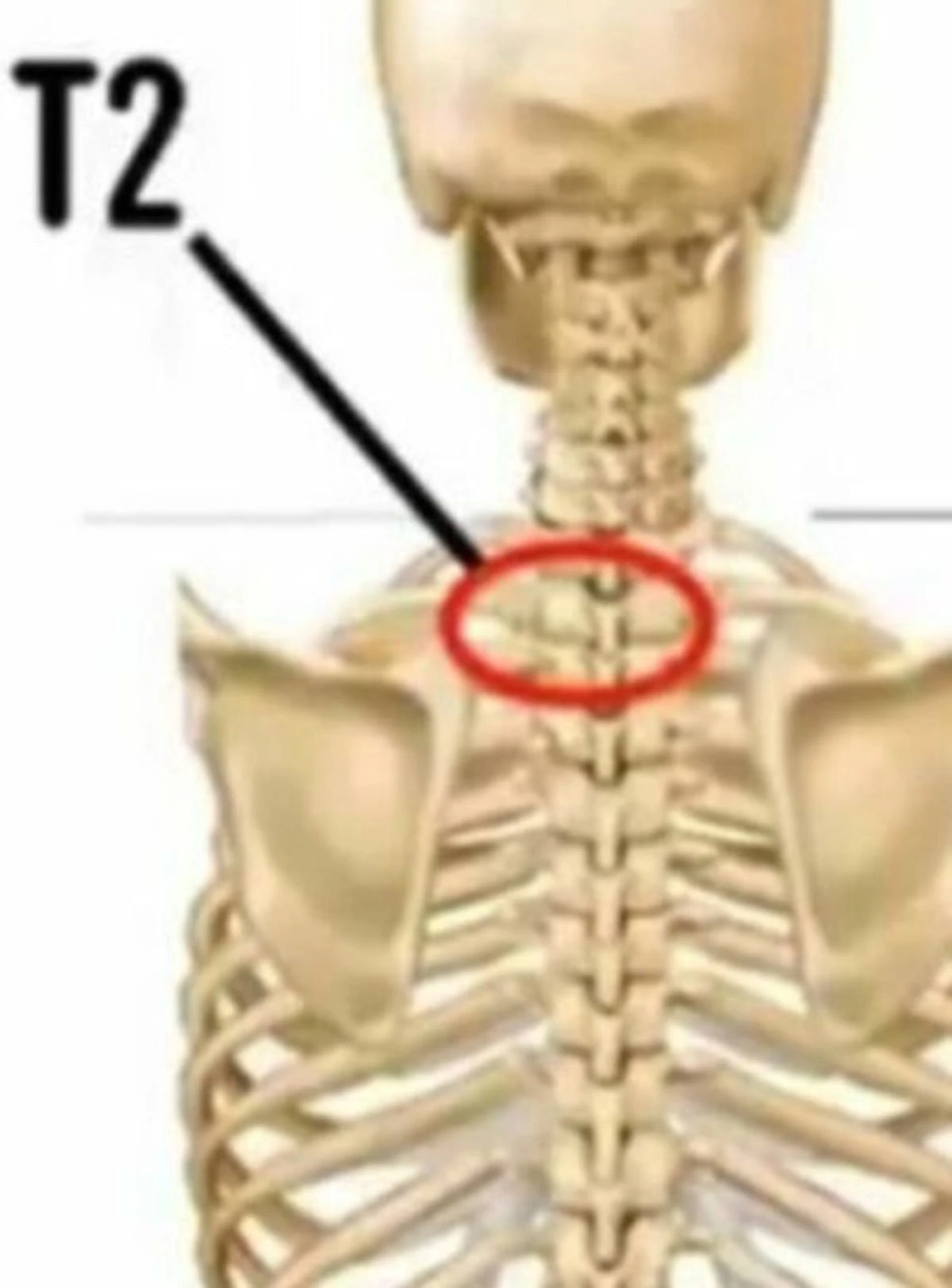 Radiografia della vertebra T2, elemento chiave nell'inchiesta su Liliana Resinovich