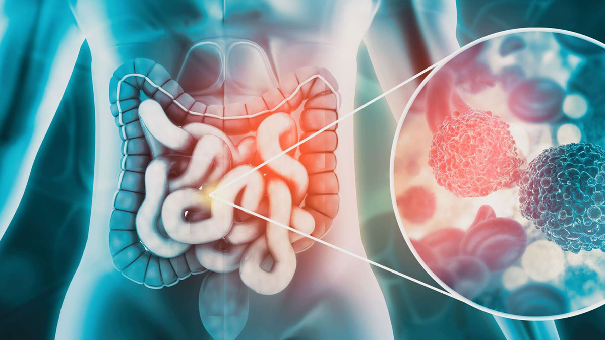 L’ospite silenzioso che può portare al cancro: a cosa fare attenzione