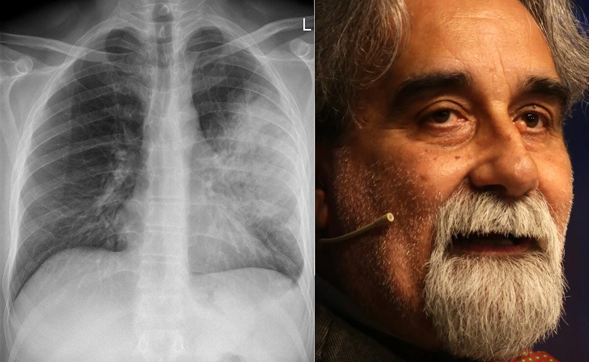 Polmonite interstiziale, il killer silenzioso che ha colpito Vessicchio: quei sintomi da non sottovalutare Polmonite interstiziale, il killer silenzioso che ha colpito Vessicchio: quei sintomi da non sottovalutare