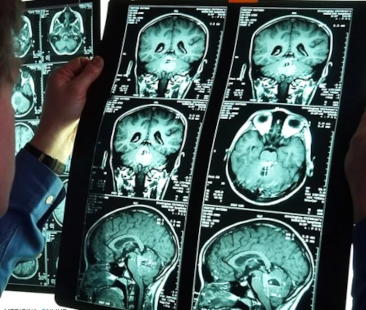 Risonanza magnetica della colonna cervicale