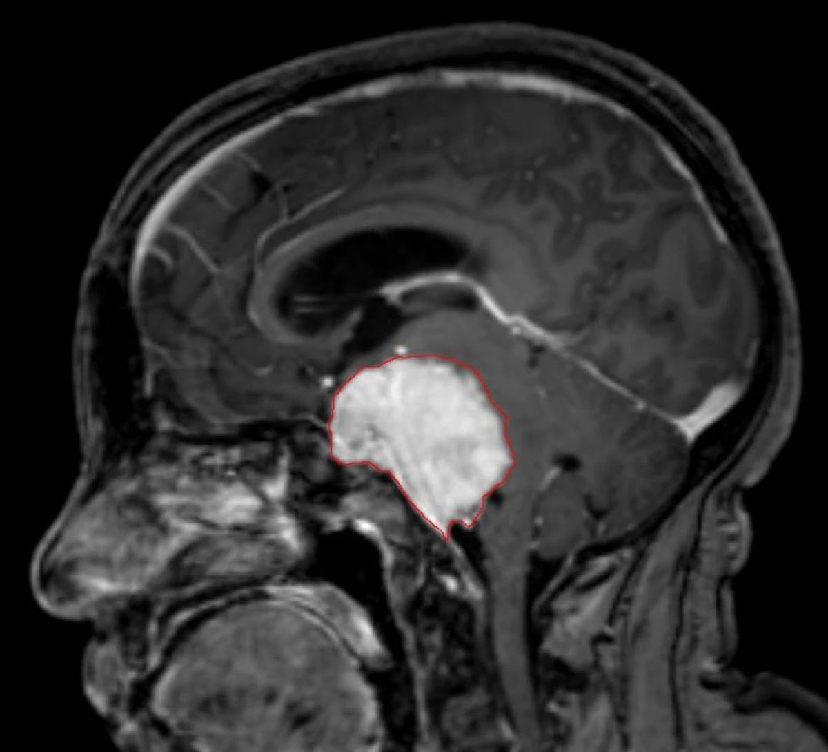 Immagine illustrativa di meningioma e strutture cerebrali