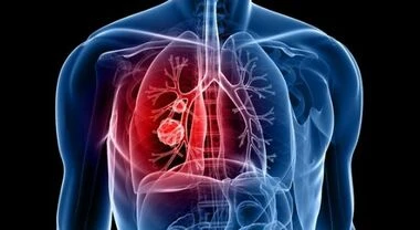 Tumore al polmone: prevenzione e riduzione del rischio legate al fumo