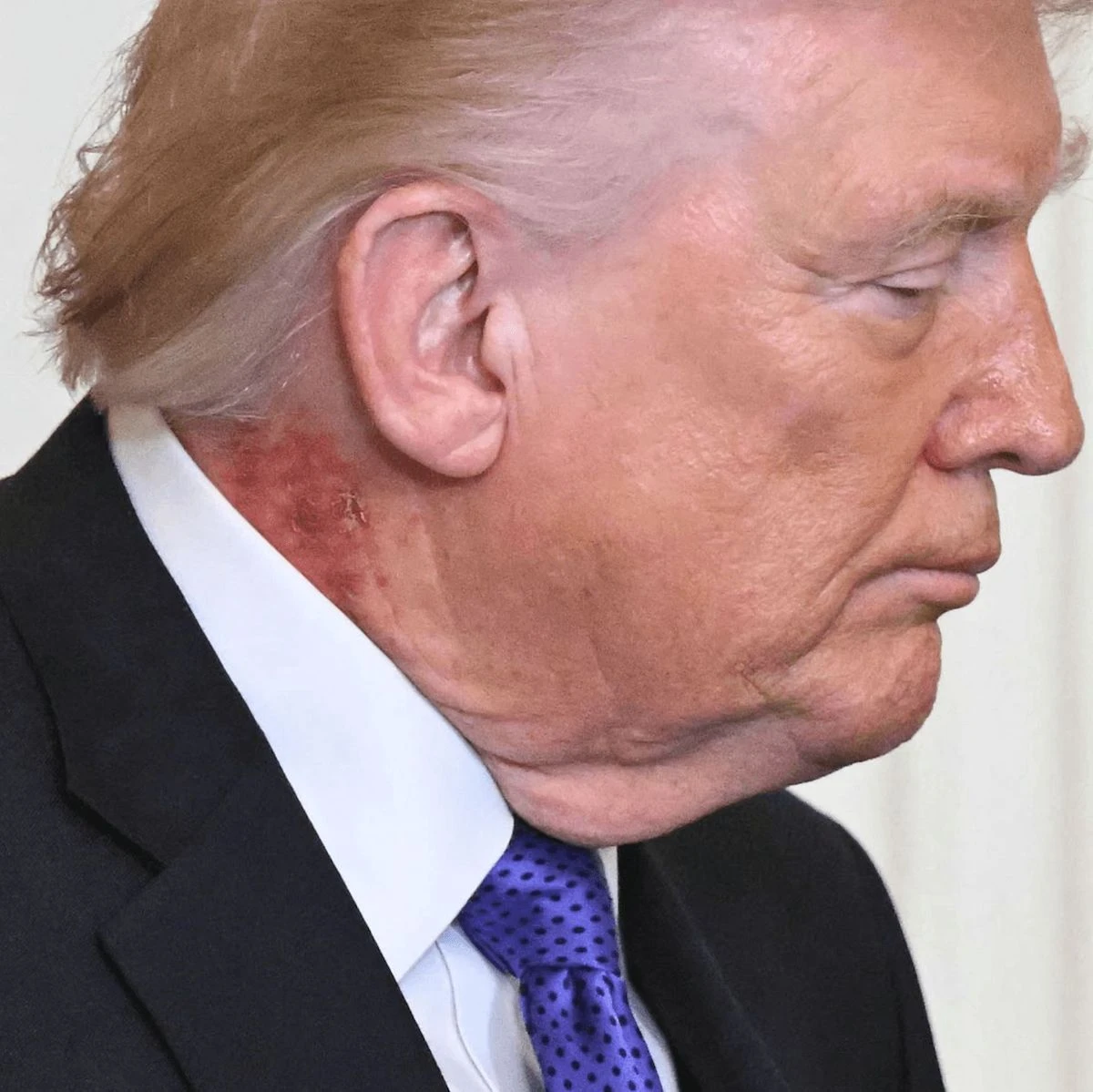 Donald Trump durante una cerimonia ufficiale con un’area arrossata sul collo