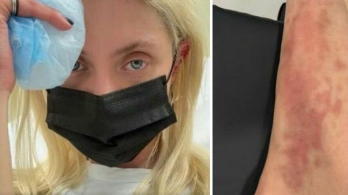 Taylor Momsen ricoverata per il morso di un ragno velenoso: apprensione per l'attrice di Gossip Girl