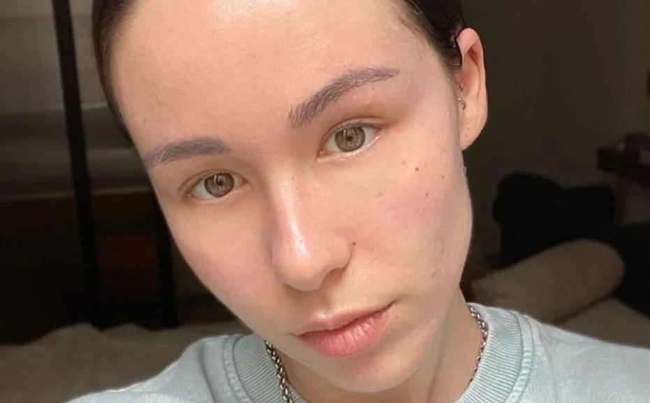 Aurora Ramazzotti lotta contro l'acne