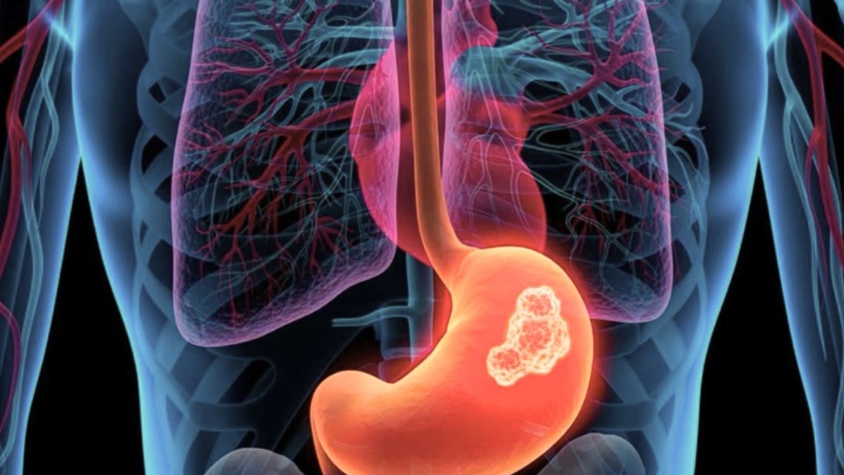 l8217alimento associato al rischio di tumore allo stomaco nelle donne fate attenzione da Tvzap.it l8217alimento associato al rischio di tumore allo stomaco nelle donne fate attenzione